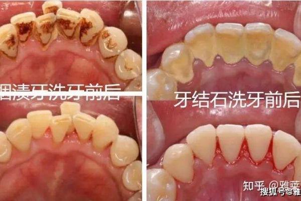 牙齿算命 有鬼牙不吉利吗